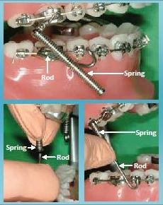 Forsus emergency procedure image